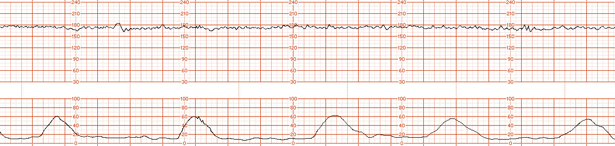 fetal strip