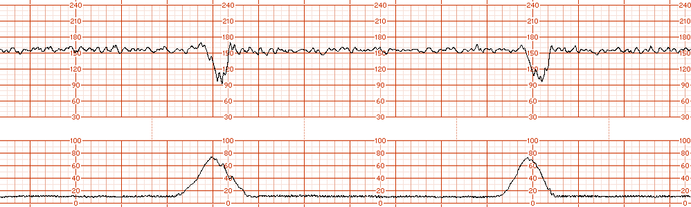 fetal strip