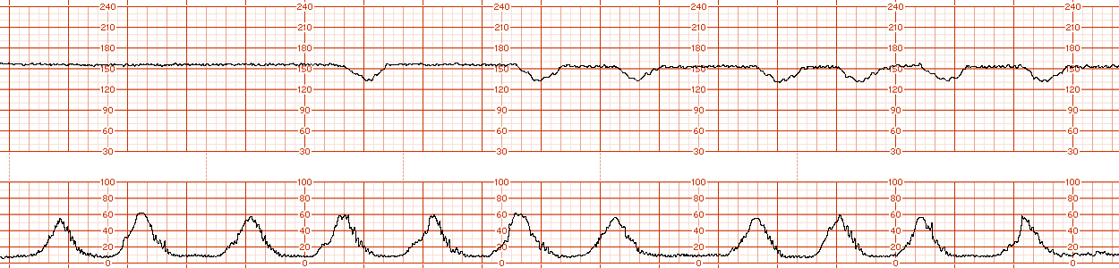 fetal strip