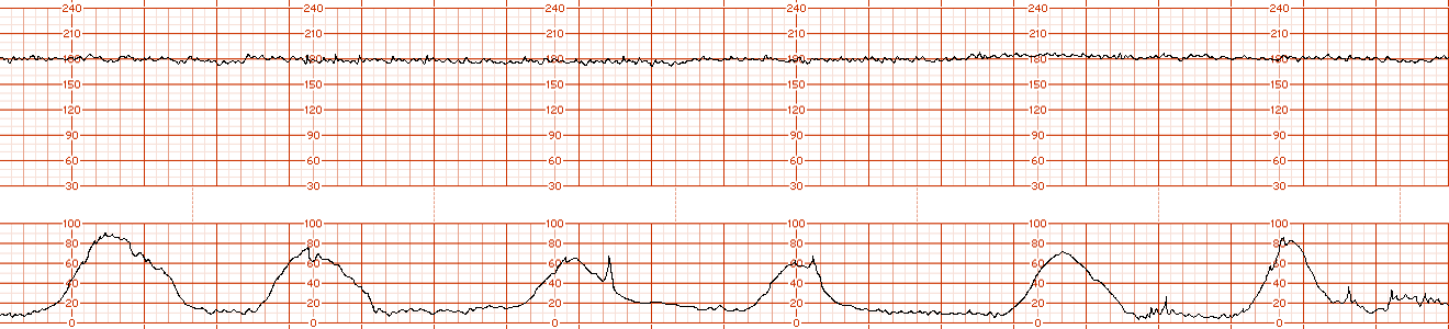 fetal strip