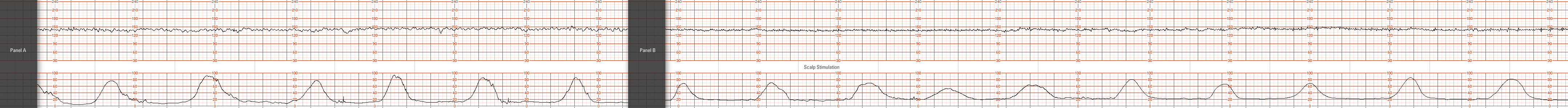 fetal strip