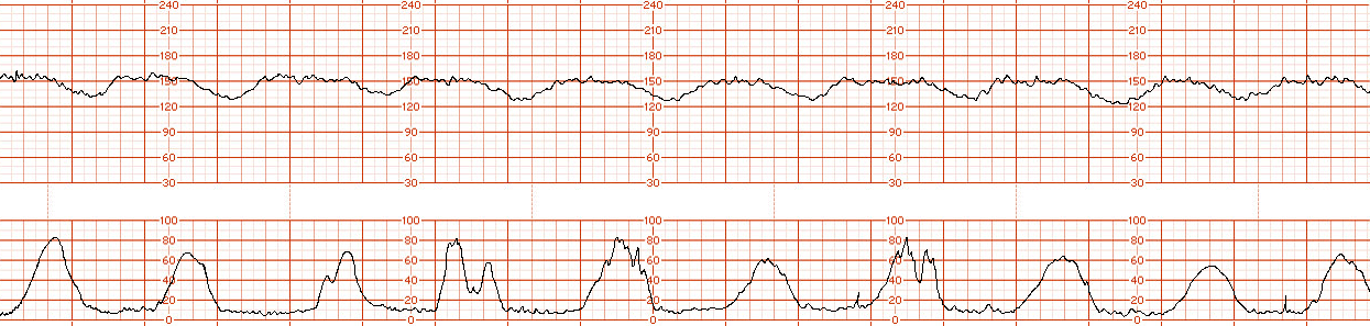 fetal strip